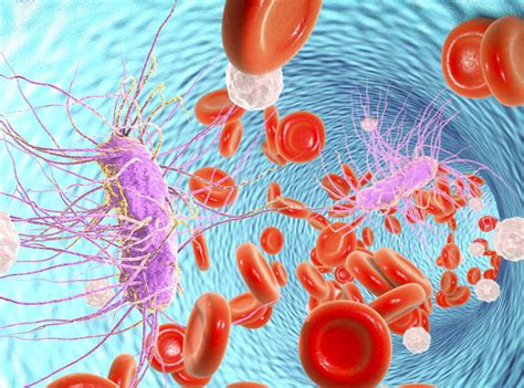Is that sepsis is (pathology) a serious medical condition in which the whole body is inflamed, and a known or suspected infection is present while septicemia is. Sepsis And Septicaemia | Homeopathy Plus