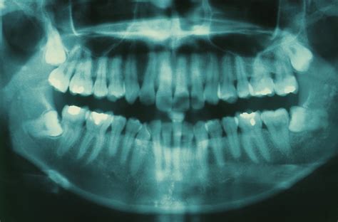 Impacted Wisdom Teeth What Is It Symptoms Diagnosis National