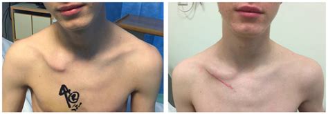 A Preoperative Appearance Of Lateral End Of The Clavicle Displaced