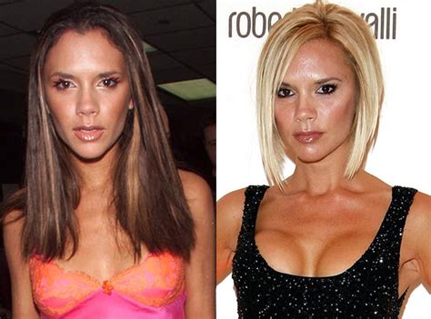 Victoria Beckham From Better Or Worse Celebs Who Have Had Plastic Surgery