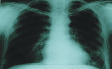 Chest Radiograph Showing Flattening Of Left Hemidiaphragm And Four