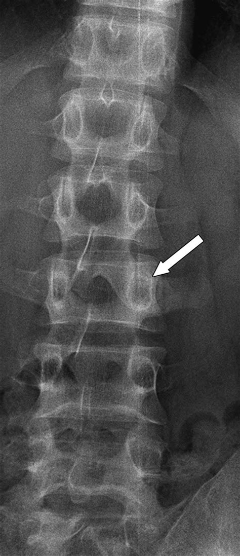 Osteoid Osteoma Spine
