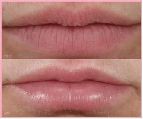 Vertical Lip Lines Botox Or Filler Or Prp