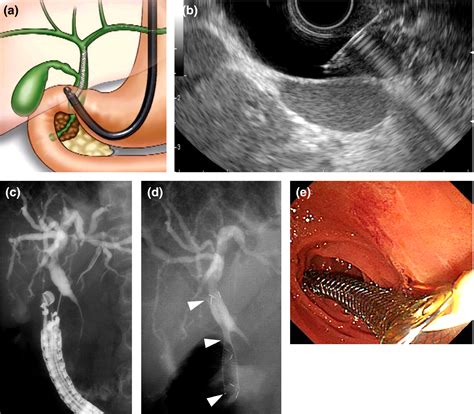 Recent Advances In Endoscopic Ultrasound‐guided Biliary Drainage