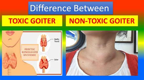 Difference Between Toxic Goiter And Nontoxic Goiter Youtube