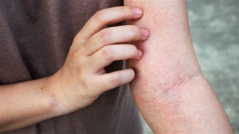 What Do Skin Rash Mean