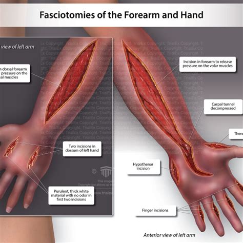 Fasciotomies Of The Forearm And Hand Trialexhibits Inc