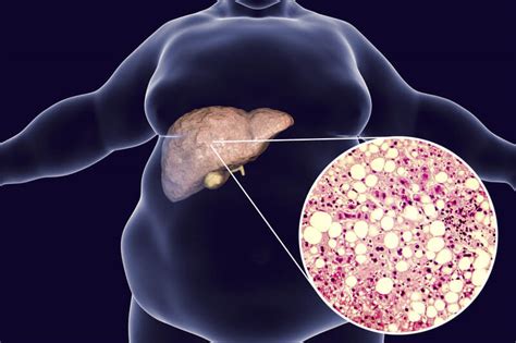 Fatty Liver Reasons Why Slim People Are At Risk Of Fatty Liver