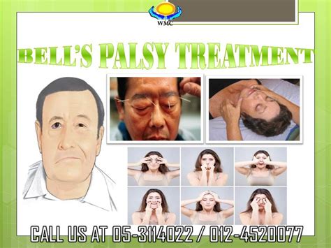 Bell S Palsy Facial Nerve Face Exercises Paralyzed Face Massage