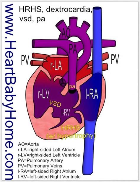 Pin På Hypoplastic Right Heart Syndrome
