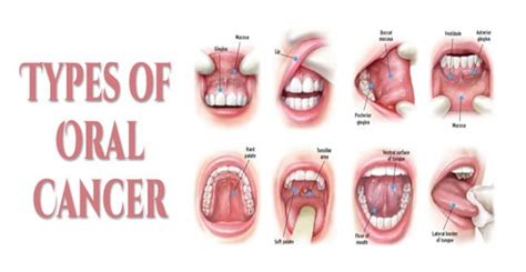 When to see a doctor. Oral Cancer: Symptoms, Causes And Risk Factors