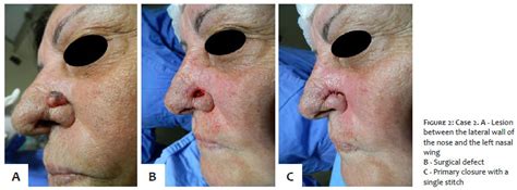 Surgical Cosmetic Dermatology Reconstruction Options For The