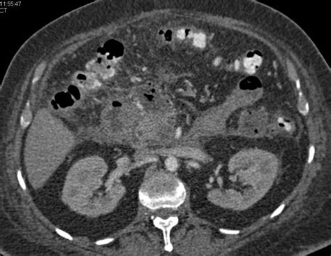 Abscess In Gallbladder And Pancreatic Bed Liver Case Studies Ctisus