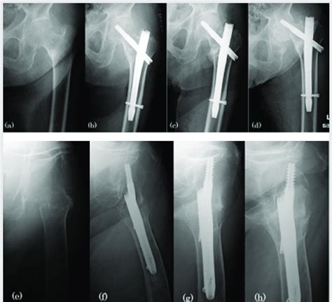 X Ray A And E An Intertrochanteric Fracture Of The Left Femur