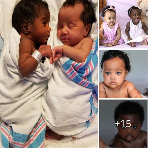 Twins Born With Different Skin Colors Girls Who Are Hardly