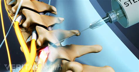 Nerve Block Injection Amara Pain Spine Management