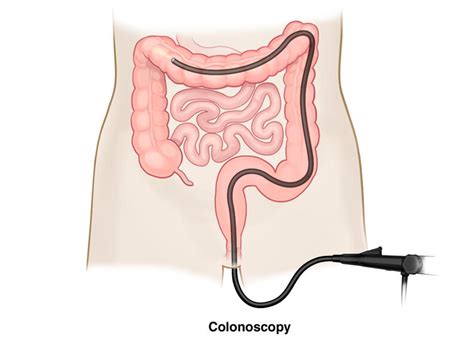What To Expect After Your Colonoscopy — Dr Terence Chua · General Surgeon And Colorectal Surgeon