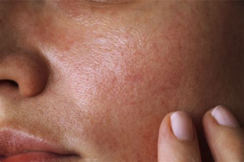 Blog Nichiduta Dermatita Atopica Sau Eczema La Copii Care Este Hot