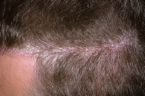 Understanding The Symptoms Of Skin Scalp Psoriasis