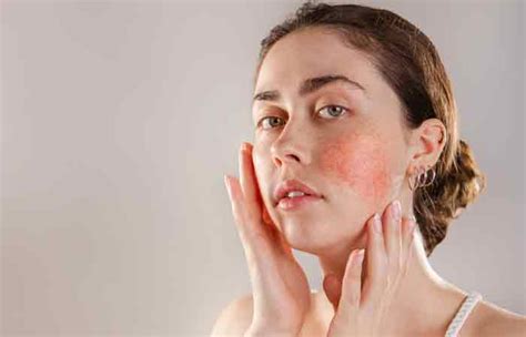 Home Remedies To Reduce Redness On The Face Prevention Tips