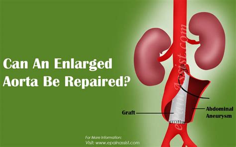 Can An Enlarged Aorta Be Repaired