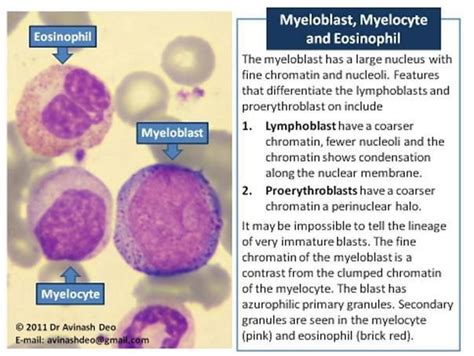 Myelocyte Vs Promyelocyte Hematology Morphology Medical Laboratory