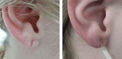 Split Earlobe Repair Leeds Before And After Skin Surgery Clinic