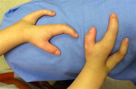 Ulnar Sided Cleft Hand Congenital Hand And Arm Differences