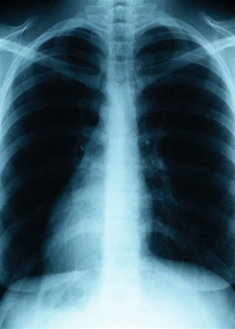 Pneumonia can be mild and only require a week of treatment before you can. TWU Health Studies: Lung Cancer Awareness