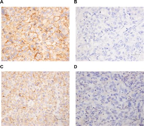 Representative Images Of Immunohistochemical Staining For Pd L1 And