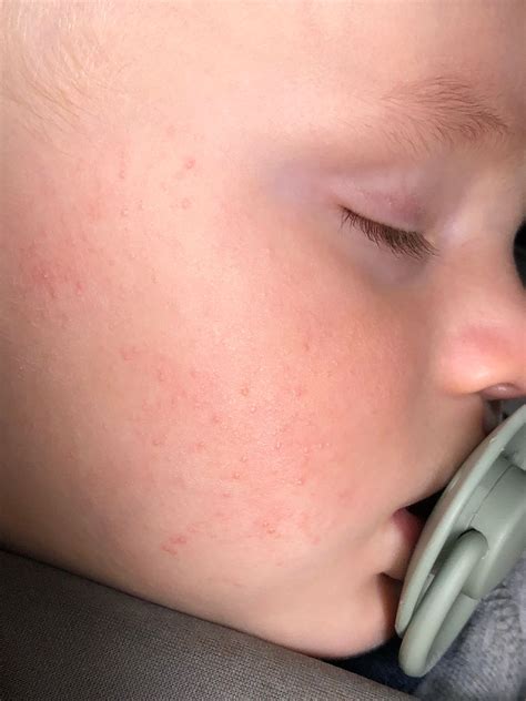 Rash Spots On Cheeks Babycentre