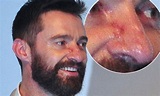 Hugh Jackman reveals the true extent of having skin cancer at X-Men ...