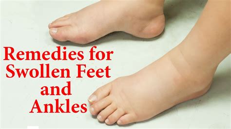 10 Natural Remedies For Swollen Feet And Ankles Ways To Reduce Edema Naturally At Home Youtube