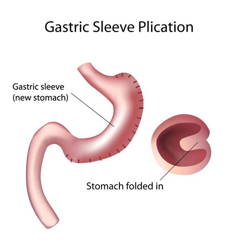 Gastric Sleeve Surgery Bc