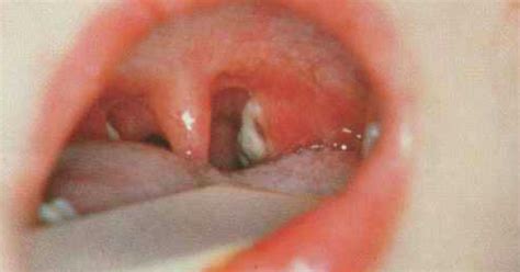 In den ländern der gemeinschaft unabhängiger staaten kommt es seit den 1990er jahren wiederholt zu größeren ausbrüchen. Dominikanische Republik: Diphtherie aus Haiti ...