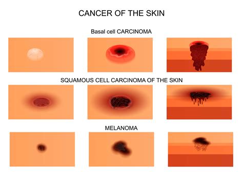 What Are The Best Essential Oils And Recipes For Skin Cancer