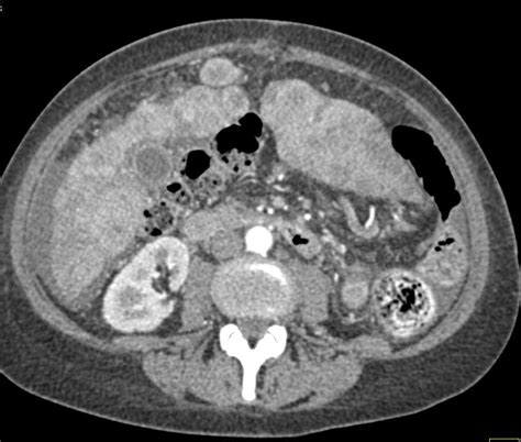 Metastatic Colon Cancer To Liver With Carcinomatosis Liver Case