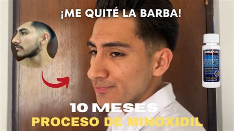 Meses Usando Minoxidil Para Crecer Barba Siendo Lampi O Youtube