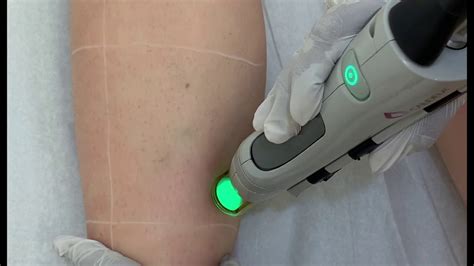 Laser Hair Removal At Advanced Derma Laser Youtube