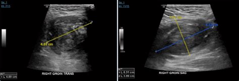 Ultrasound Of The Right Groin Showing 63 × 40 × 49 Cm Hematoma