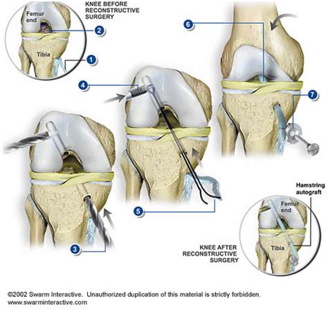 Anterior Cruciate Ligament Acl Surgery Health Life Media