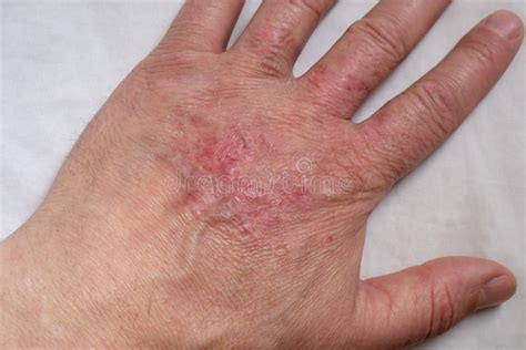 Healing Burns On The Arm Scars On The Skin Of The Hand After A Burn