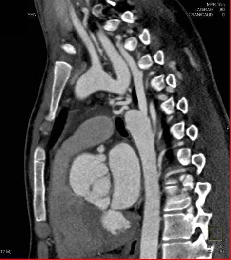 Occlusion Of Aortic Due To Severe Coarctation Of The Aorta Vascular