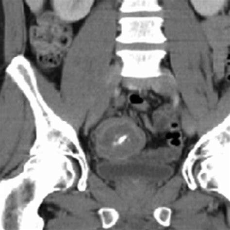 Coronal View Of The Abdominal Computed Tomography Showing A 6 Cm Round