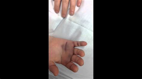 Eilyshs Hand Brokenfractured Pinky Youtube