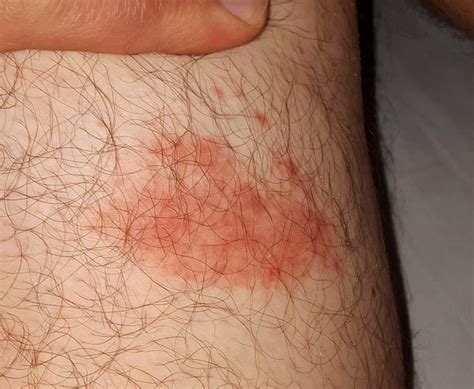 Lyme Disease Rash Photos Early Stage Bull’s Eye And Atypical Rashes Mom Goes Camping