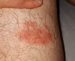 Lyme Disease Rash Photos: Early-Stage, Bull’s-Eye, and Atypical Rashes ...