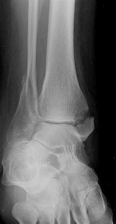 Ankle X Rays Dont Forget The Bubbles