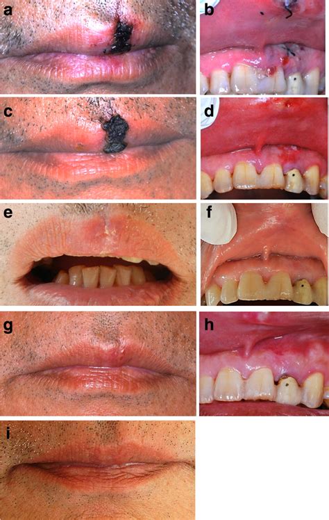 Healing Of Open Upper Lip Vermillion Wounds Irradiated With Co2 Laser