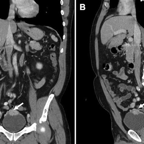 Abdomen And Pelvis Computed Tomography Of Bladder Paraganglioma A